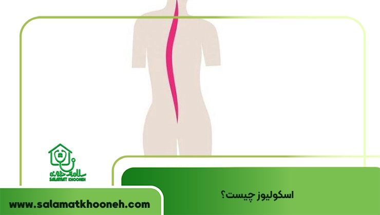اسکولیوز
