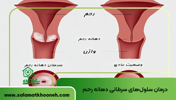 درمان سلول‌های سرطانی دهانه رحم