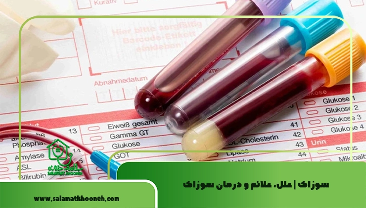 سوزاک