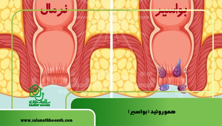 هموروئید (بواسیر)