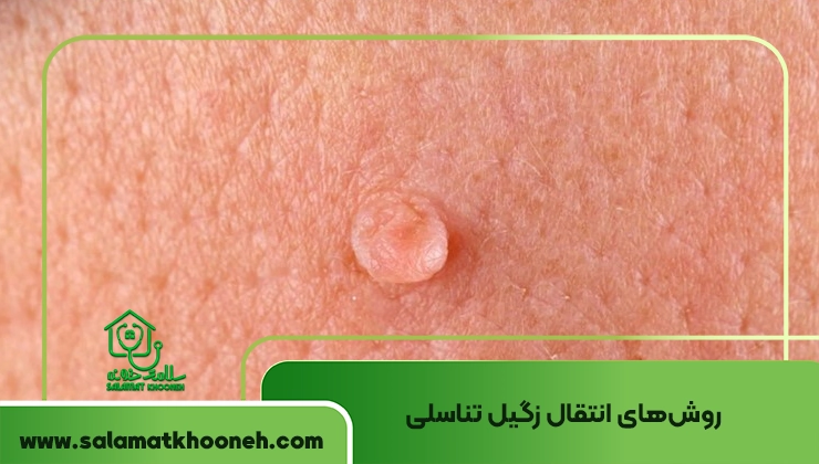 روش‌های انتقال زگیل تناسلی