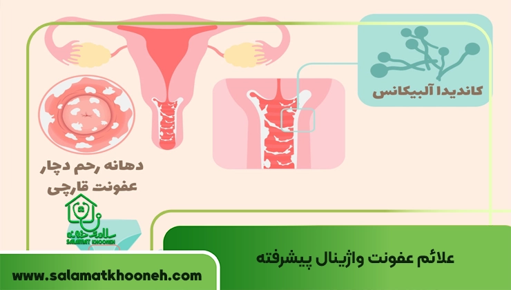 علائم عفونت واژینال پیشرفته