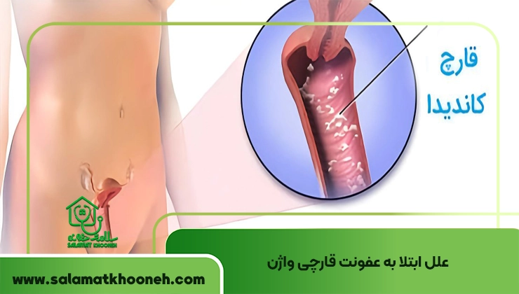 علل ابتلا به عفونت قارچی واژن