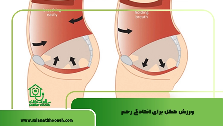 ورزش کگل برای افتادگی رحم