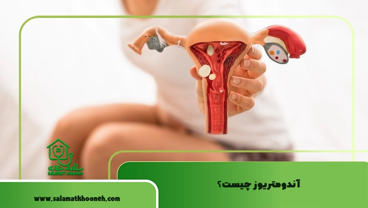 آندومتریوز