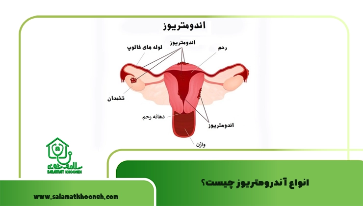 انواع آندرومتریوز