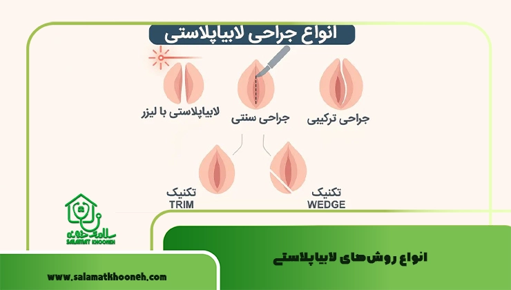 انواع روش‌های لابیاپلاستی