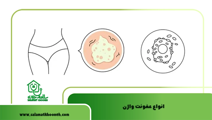 انواع عفونت واژن