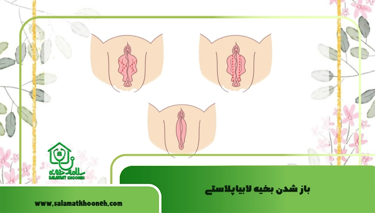 باز شدن بخیه لابیاپلاستی
