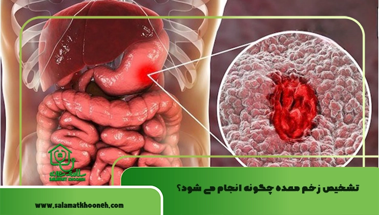 تشخیص زخم معده