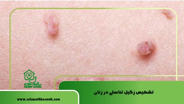 تشخیص زگیل تناسلی در زنان