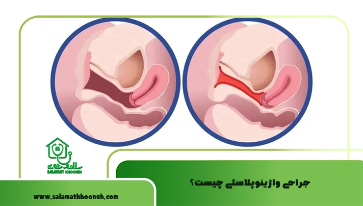 واژینوپلاستی