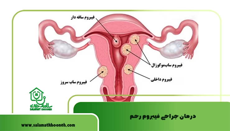 درمان جراحی فیبروم رحم