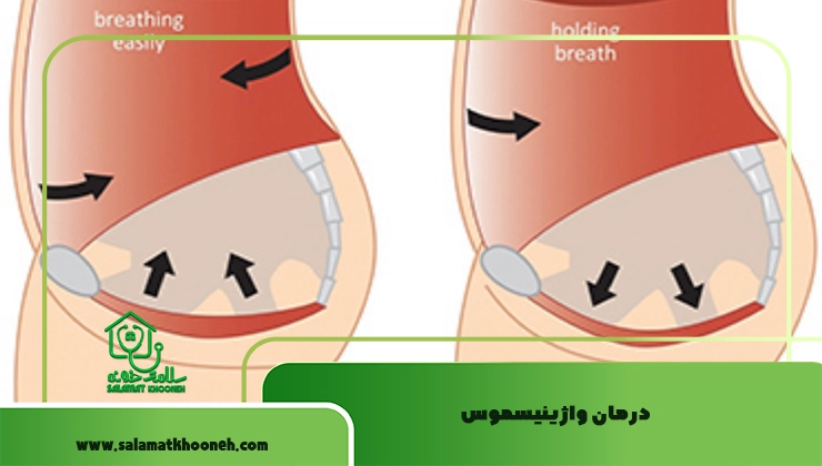 درمان واژینیسموس
