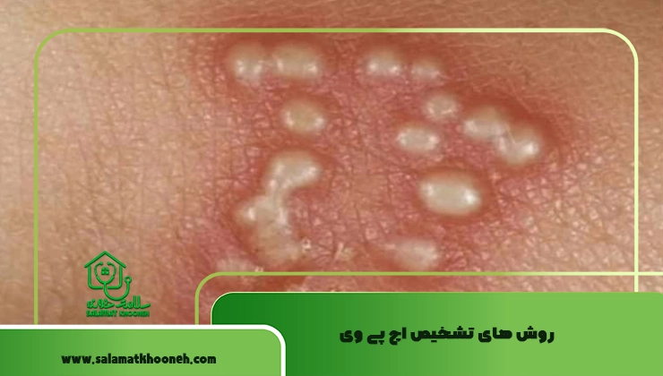روش های تشخیص اچ پی وی