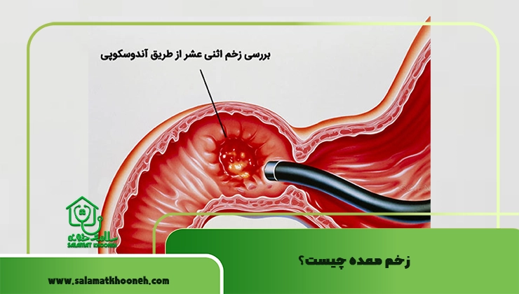 زخم معده