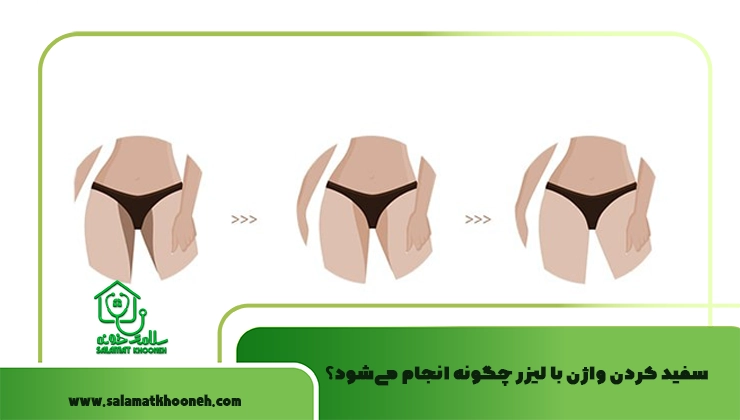سفید کردن واژن با لیزر چگونه انجام می‌شود؟