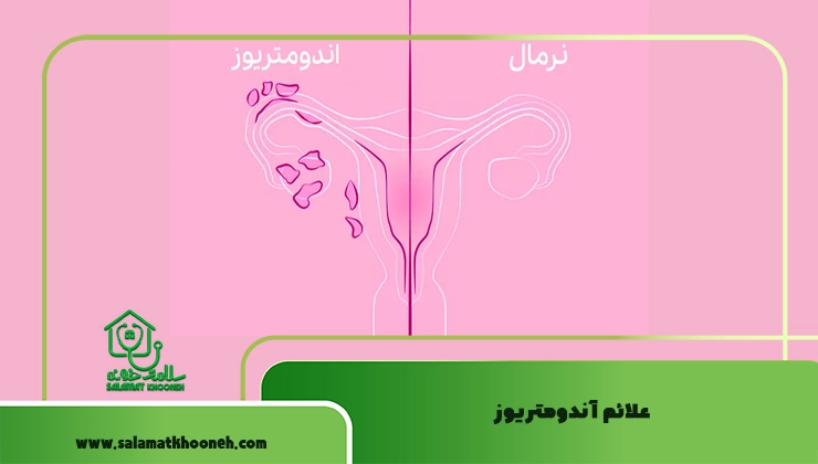 علائم آندومتریوز