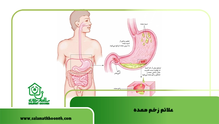 علائم زخم معده
