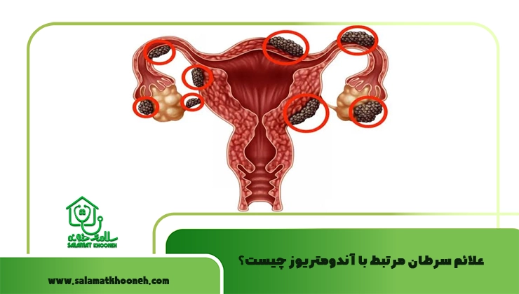 علائم سرطان مرتبط با آندومتریوز