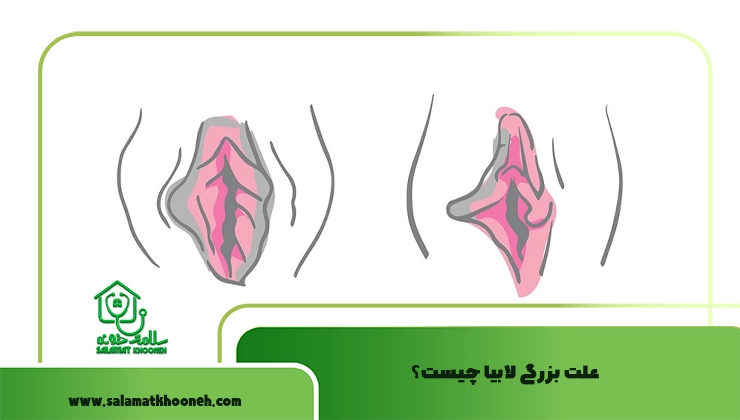 علت بزرگی لابیا چیست؟