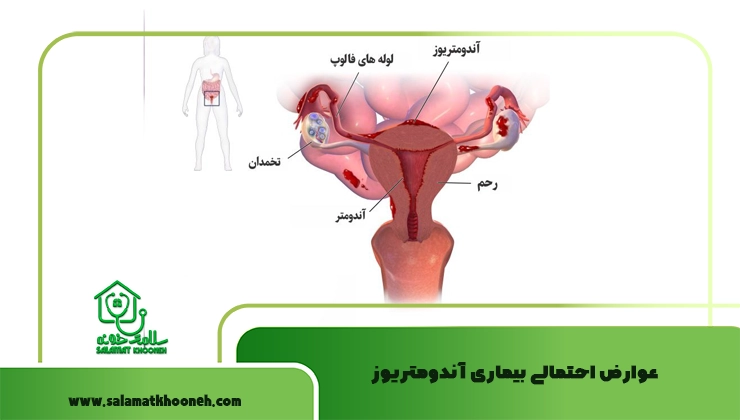 عوارض احتمالی بیماری آندومتریوز