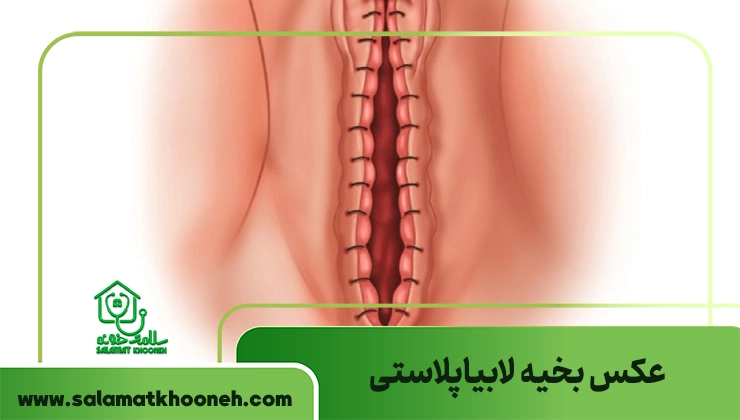 عکس بخیه لابیاپلاستی