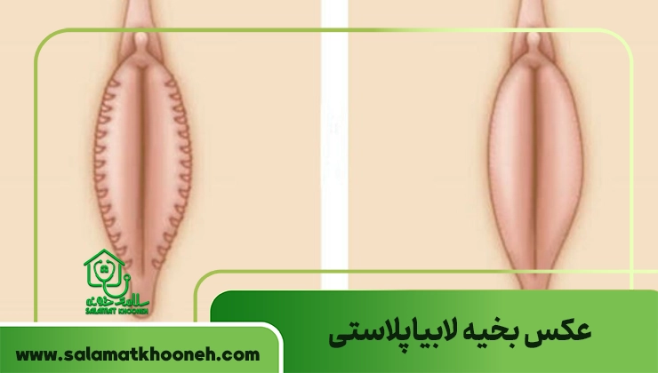 عکس بخیه لابیاپلاستی