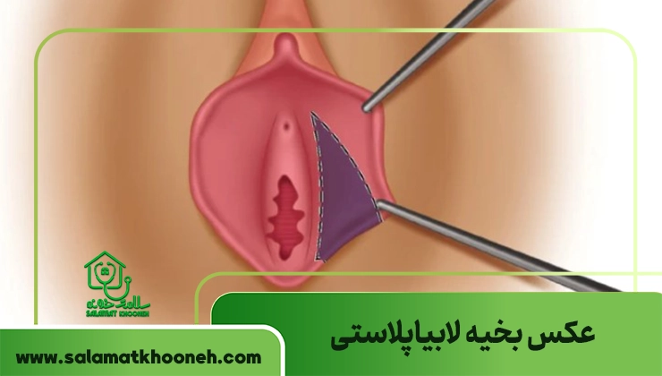 عکس بخیه لابیاپلاستی