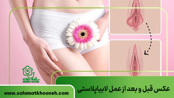 عکس قبل و بعد از عمل لابیاپلاستی