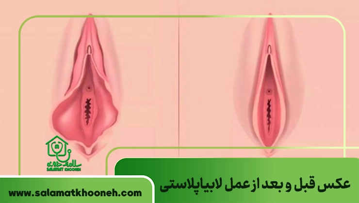 عکس قبل و بعد از عمل لابیاپلاستی