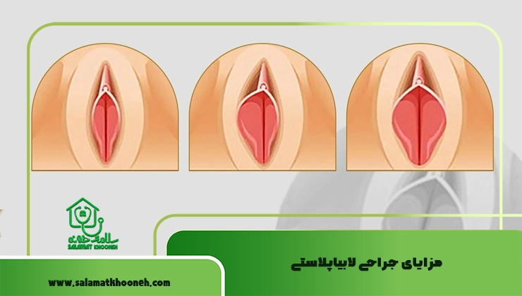 مزایای جراحی لابیاپلاستی