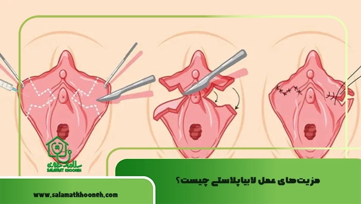 مزایا جراحی لابیاپلاستی
