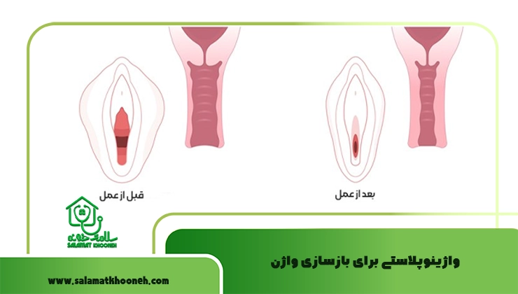 واژینوپلاستی برای بازسازی واژن