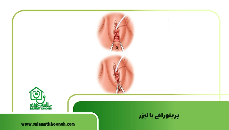 پرینورافی با لیزر