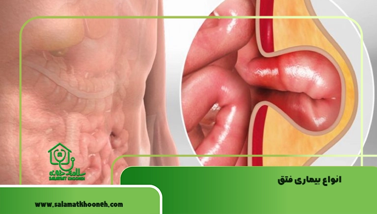 انواع بیماری فتق