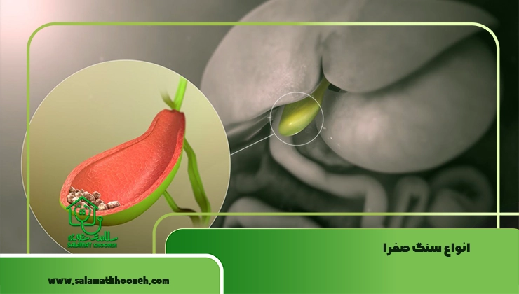 انواع سنگ صفرا