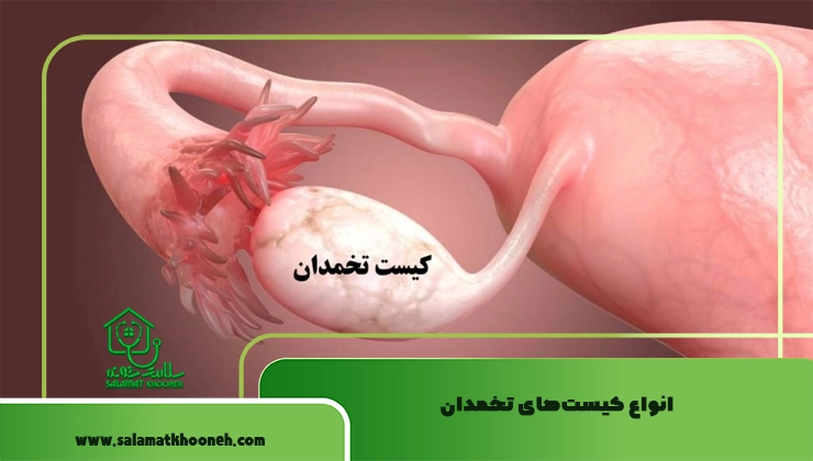 انواع کیست‌های تخمدان