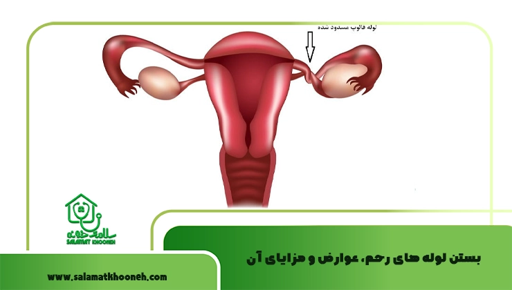 بستن لوله های رحم