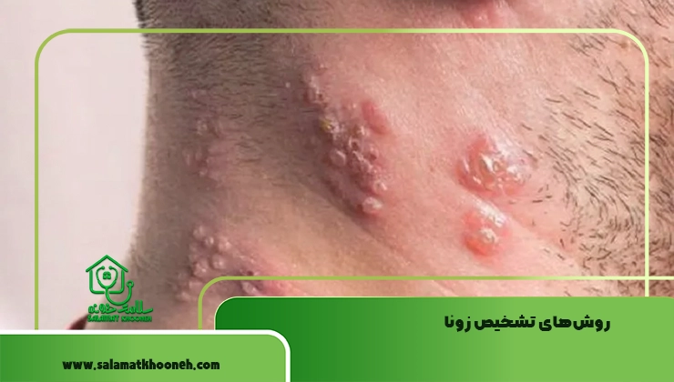 تشخیص بیماری زونا 