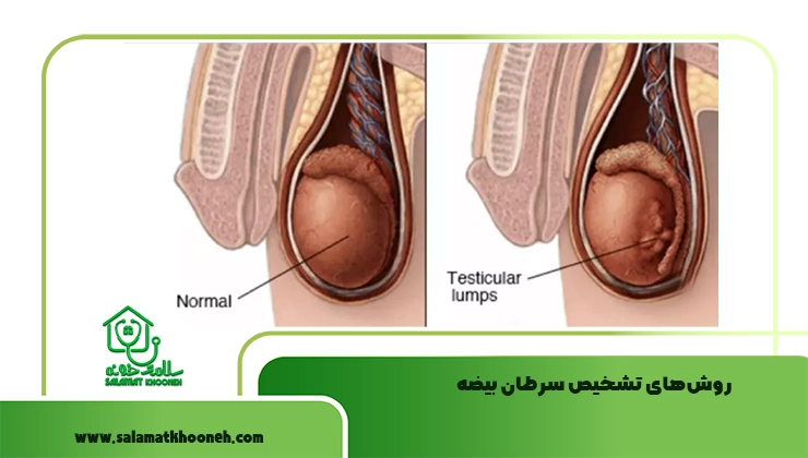 تشخیص سرطان بیضه