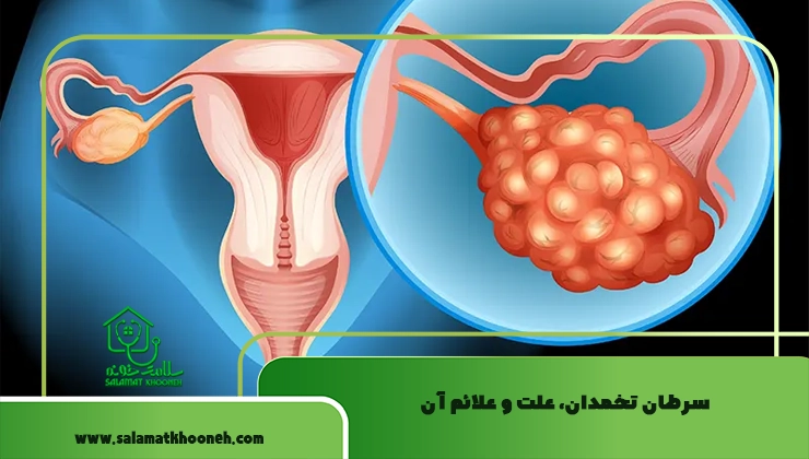 سرطان تخمدان