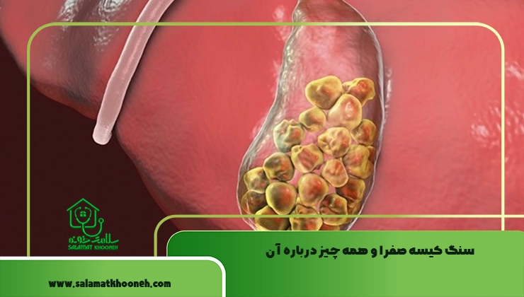 سنگ کیسه صفرا