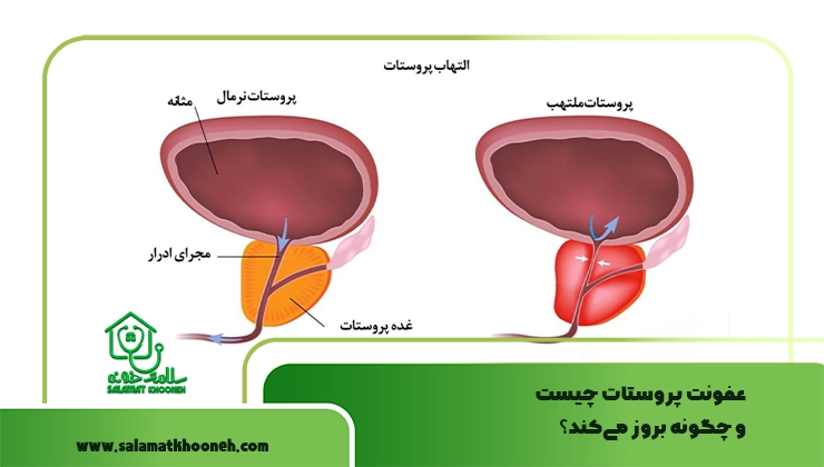 عفونت پروستات چیست