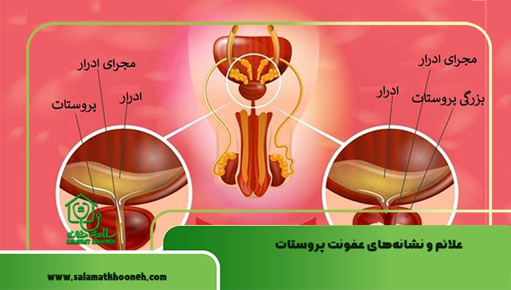 علائم عفونت پروستات