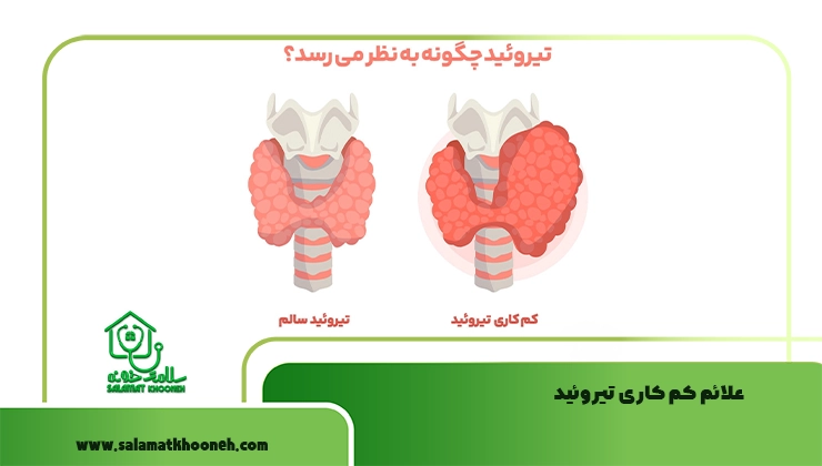 علائم کم کاری تیروئید