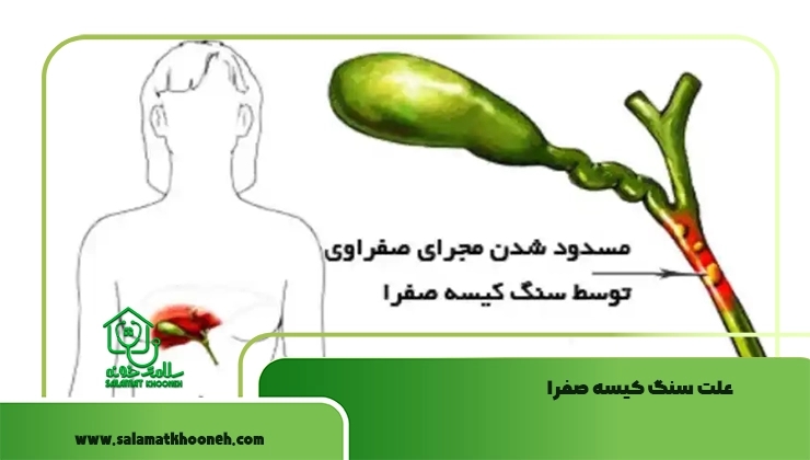 علت سنگ کیسه صفرا
