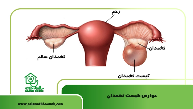 عوارض کیست تخمدان