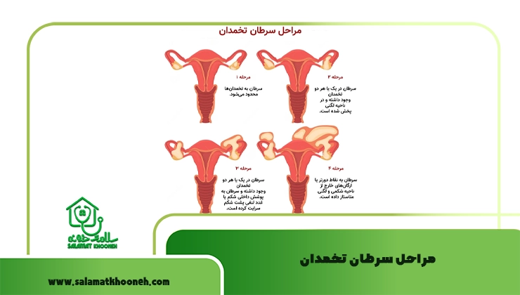 مراحل سرطان تخمدان