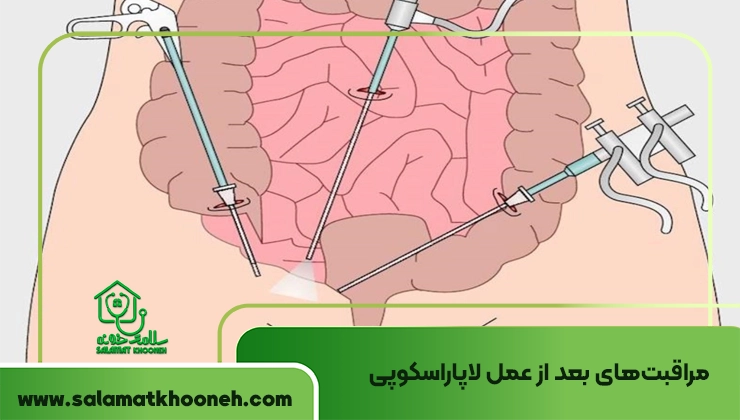 مراقبت‌های بعد از عمل لاپاراسکوپی